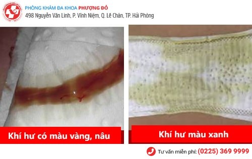 Bệnh khí hư là gì? Có chữa được không?