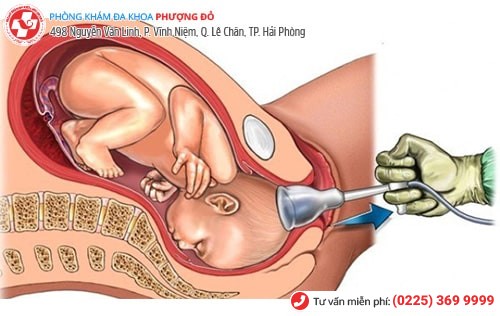 Bỏ thai an toàn theo tuần tháng tại Đa Khoa Phượng Đỏ