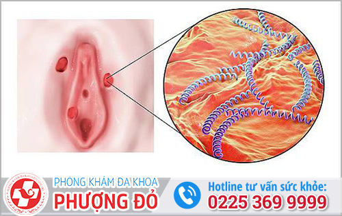 Giang mai ở nữ giới là gì?