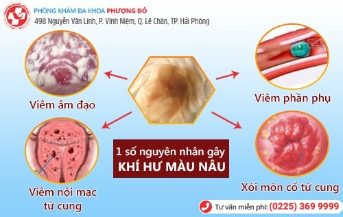 Khí hư ra màu nâu là bị gì?