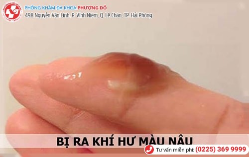 Khí hư ra màu nâu là bị gì?