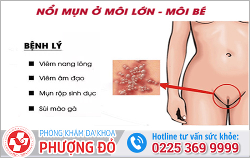 Mụn ở môi lớn, môi bé là bệnh gì? 