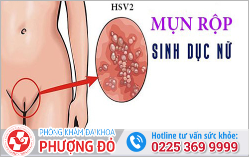 Triệu chứng mụn rộp sinh dục ở nữ
